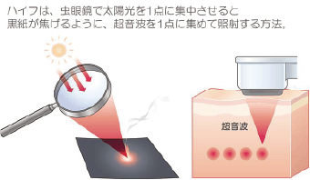 ハイフは、虫眼鏡で太陽光を1点に集中させると黒紙が焦げるように、超音波を1点に集めて照射する方法。